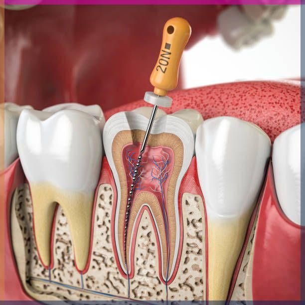Root Canal Treatment
